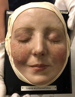 Kunst_und_Medizin__Volger_Lotte__Lupus_vulgaris.jpg